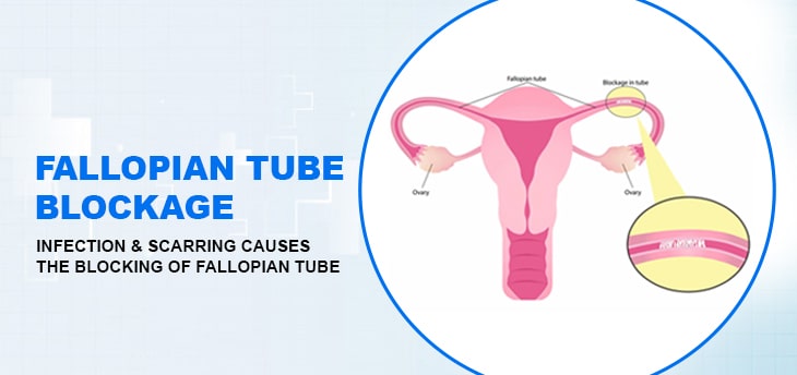 Fallopian tube blockage Treatment
